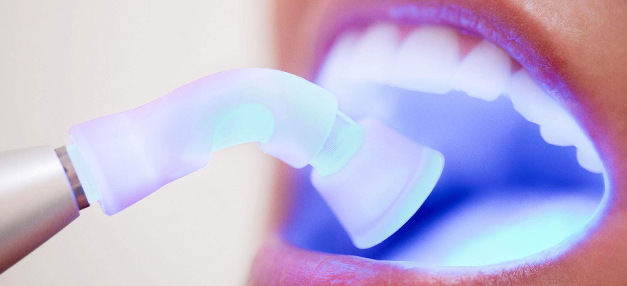 odontoiatria conservativa, cura carie, cura denti fratturati